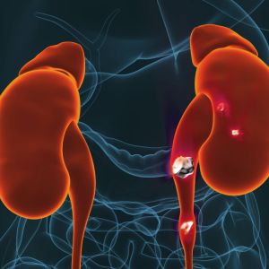 kidney-stones